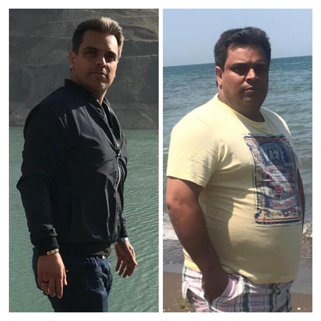 قبل و بعد از عمل