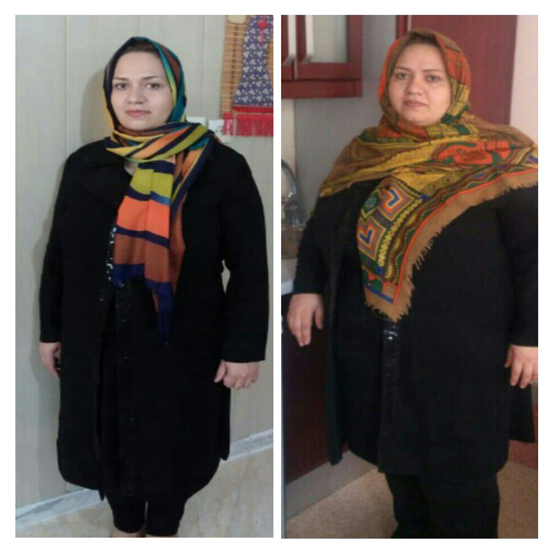 قبل و بعد از عمل