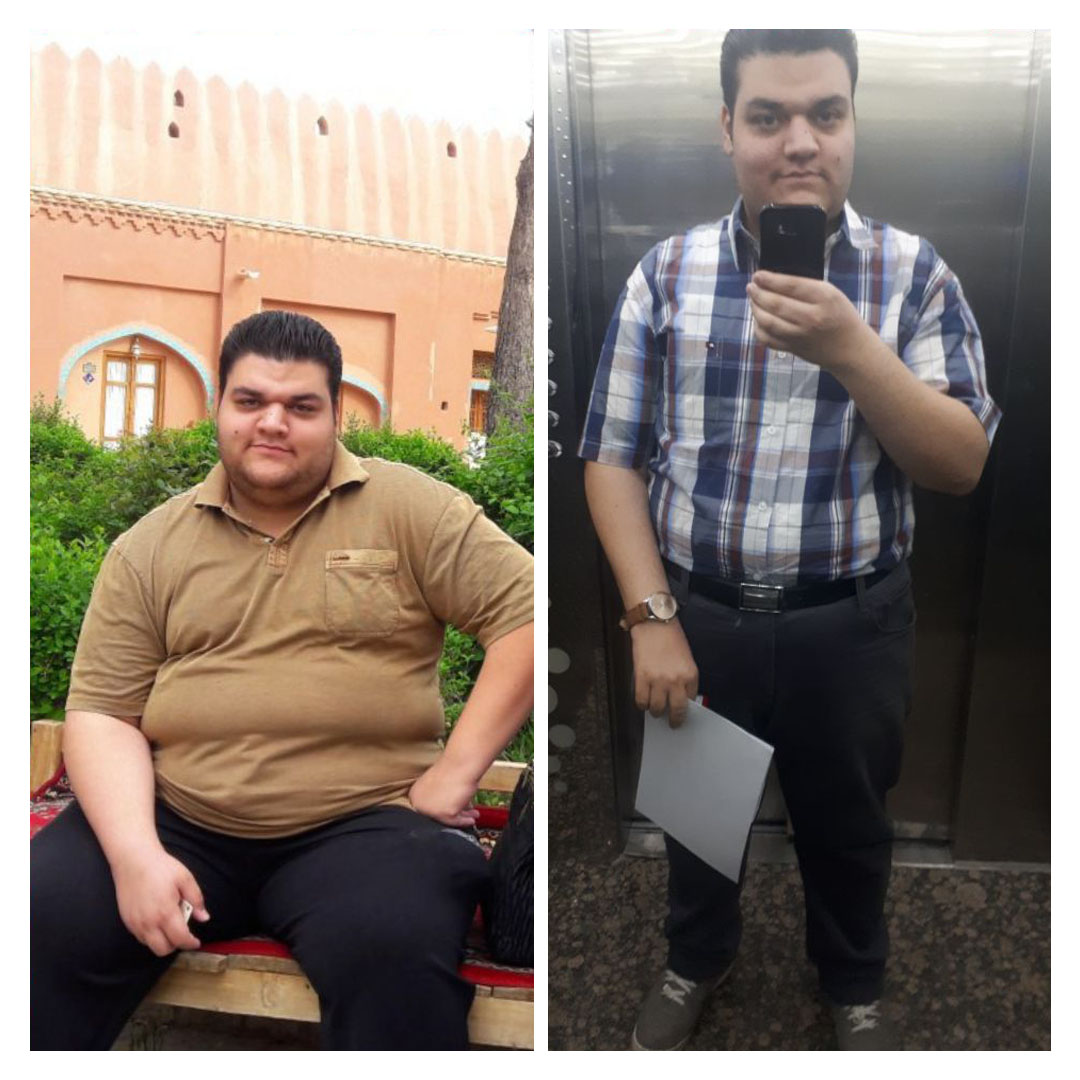 قبل و بعد از عمل