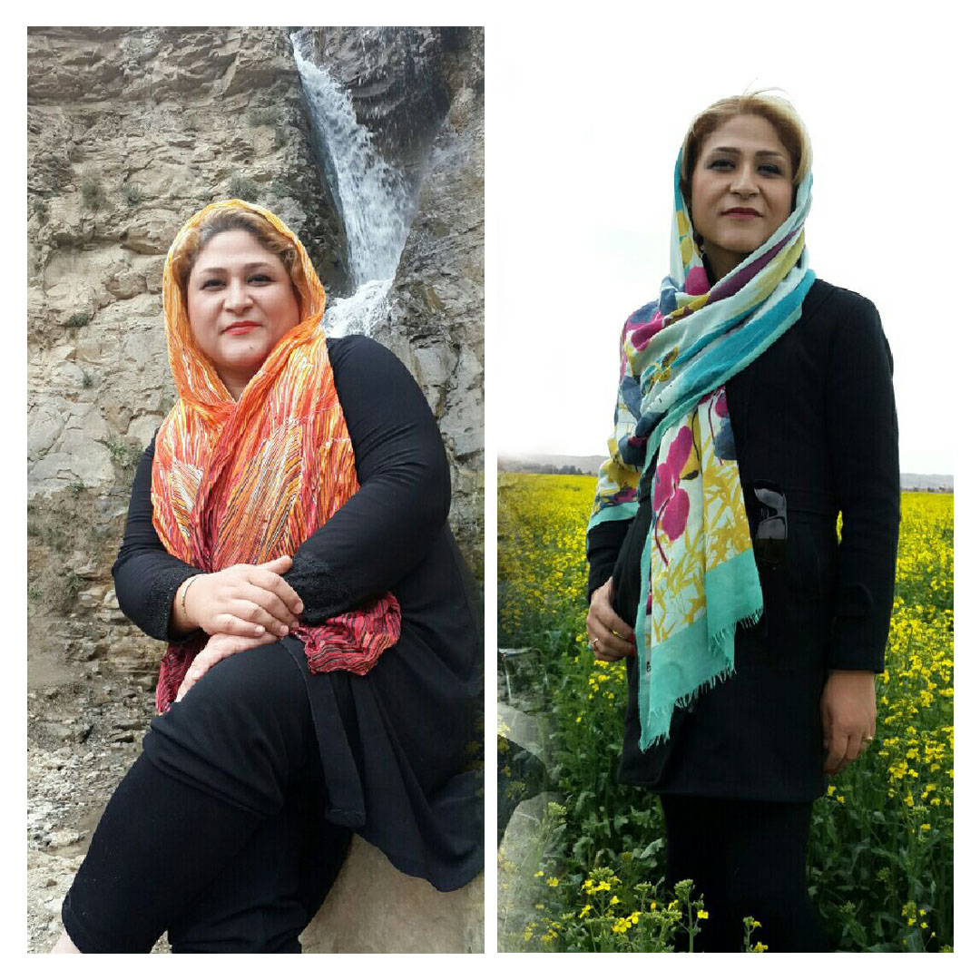 قبل و بعد از عمل