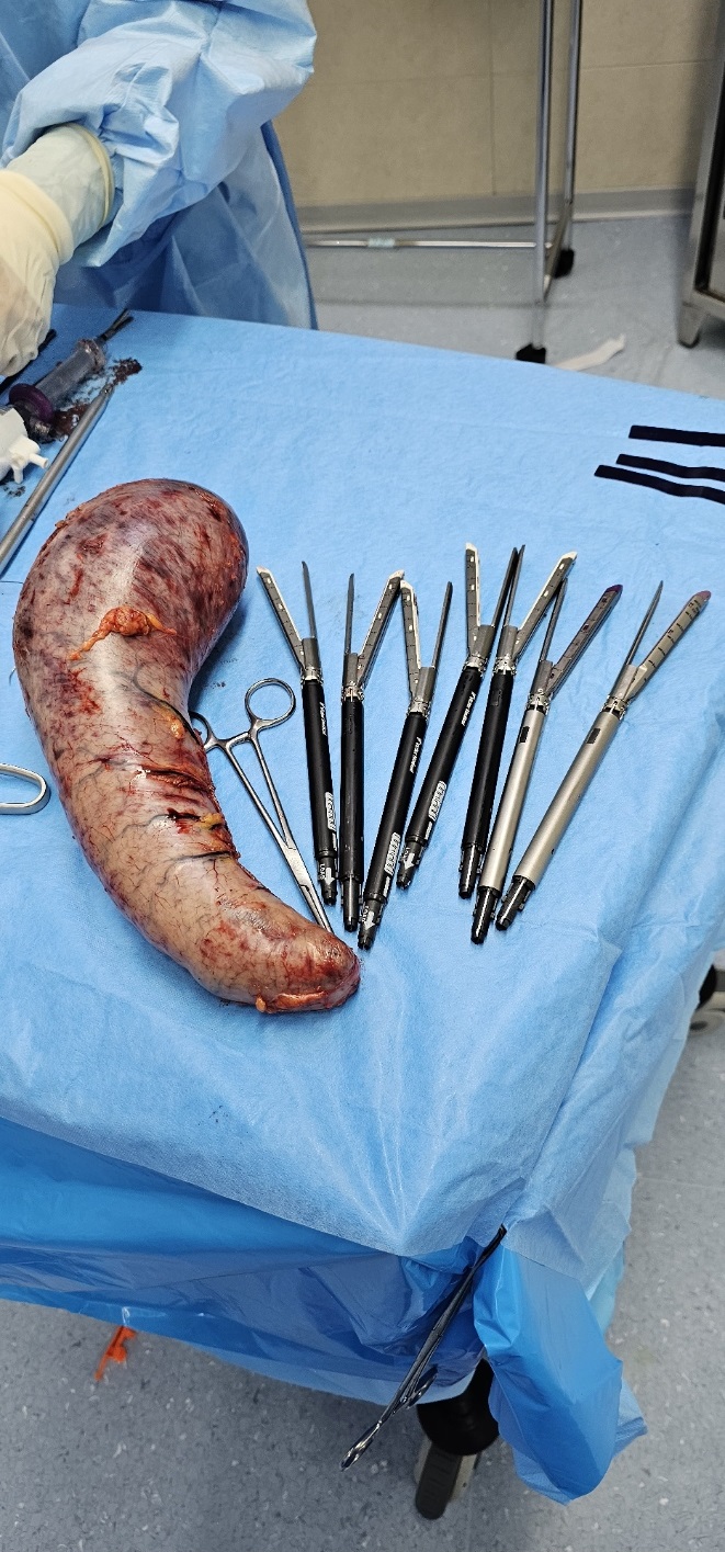 اسلیو گاسترکتومی