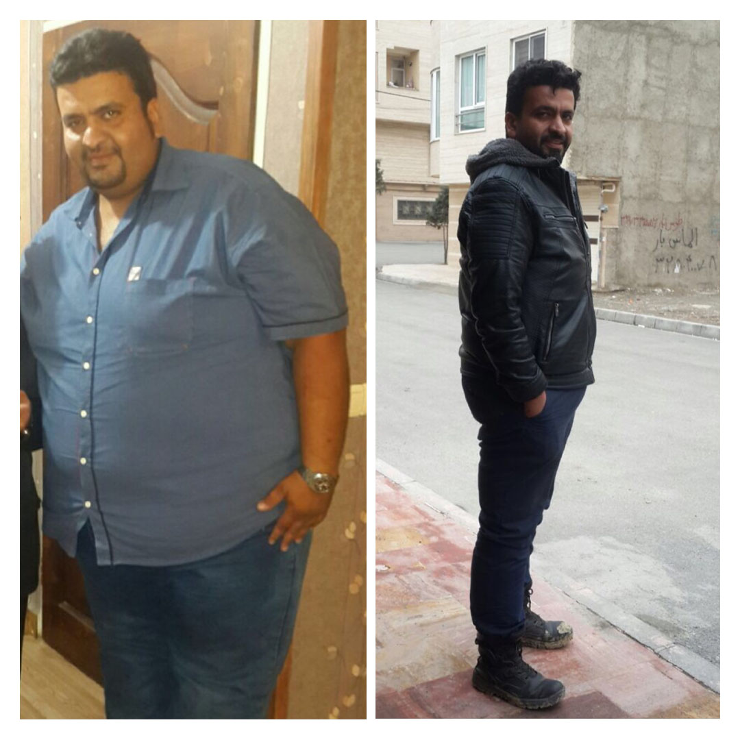 قبل و بعد از عمل