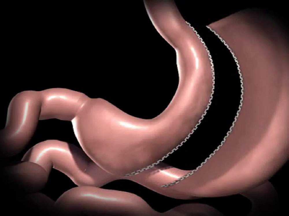 انیمیشن عمل جراحی اسلیو معده