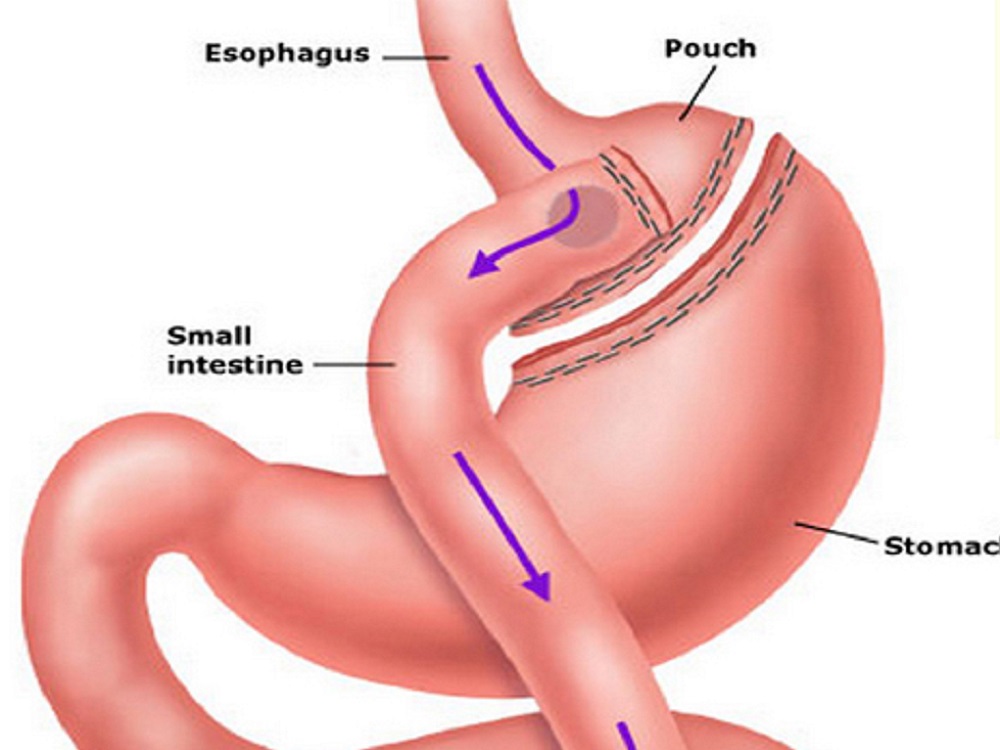 انیمیشن عمل جراحی مینی بای پس معده