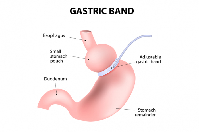 حلقه گذاری یا باندینگ معده