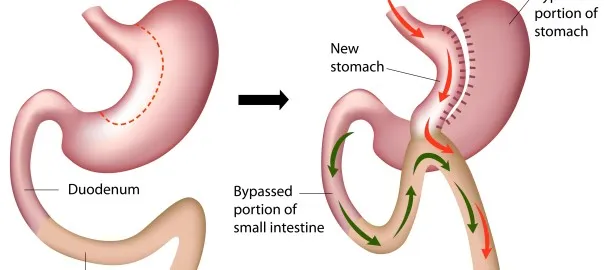 جراحی مینی بای پس معده